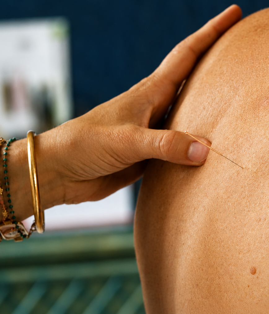 acupuncture verticale